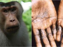 Cara Mencegah dan Mengobati Penyakit Cacar Monyet
