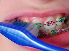 Cara Merawat Gigi Berbehel