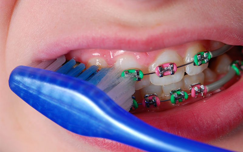Cara Merawat Gigi Berbehel